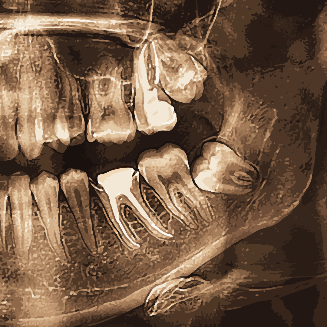 Cirurgia Bucomaxilofacial